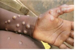 congo-records-more-than-530-deaths-from-mpox-in-2024