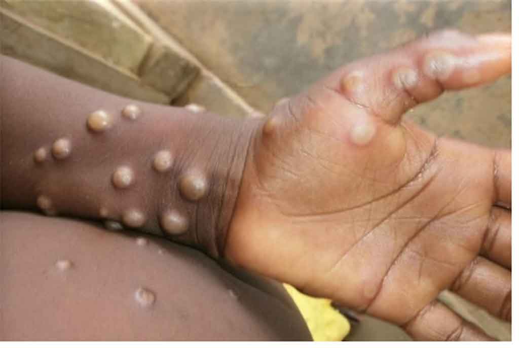 congo-records-more-than-530-deaths-from-mpox-in-2024